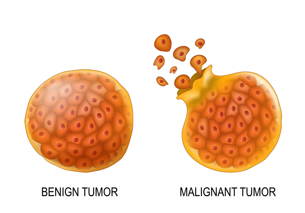 Brain Tumours Causes Symptoms Treatment Options And The Role Of CT Scan Machines My Blog